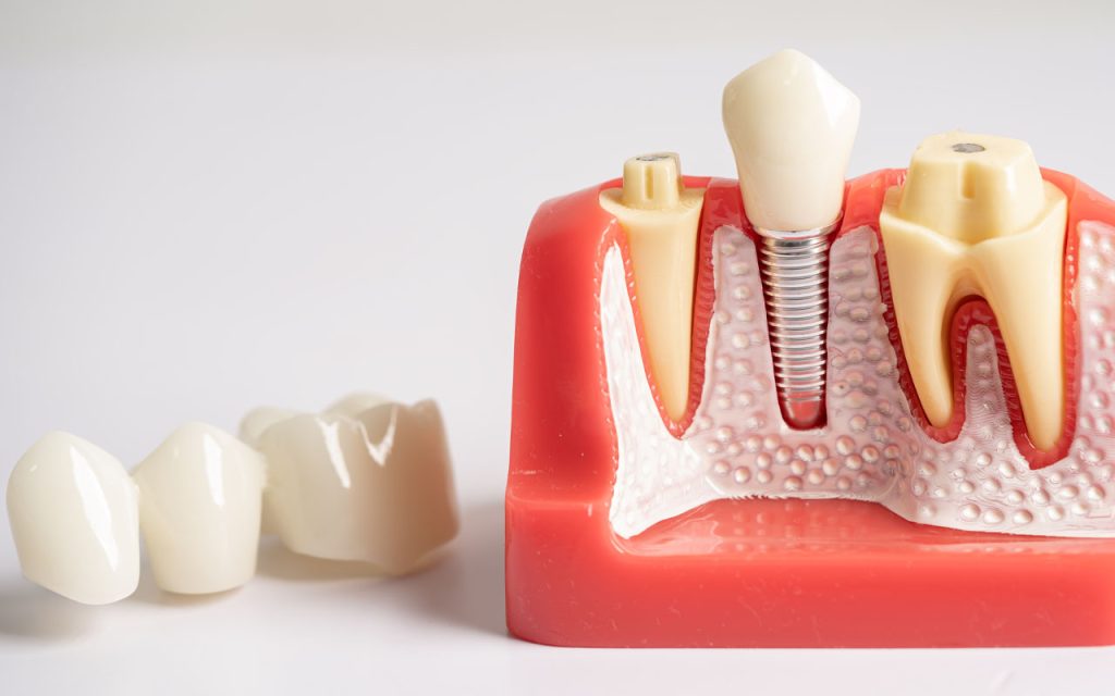 Tooth Implant vs. Dental Bridge Pros and Cons & Differences
