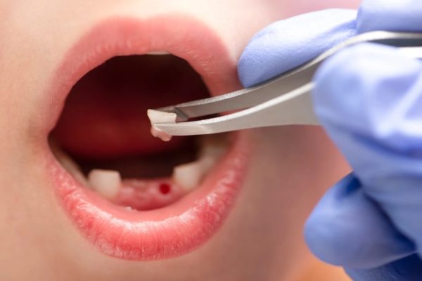 Trẻ bắt đầu thay răng vĩnh viễn ở độ tuổi nào? Trẻ bắt đầu thay răng vĩnh viễn ở độ tuổi nào?