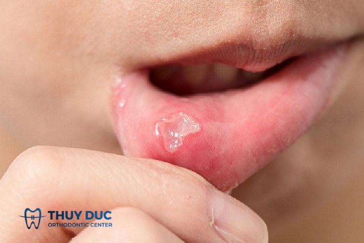 Hình ảnh nhiệt miệng: Phân biệt với các vết loét khác - Nha Khoa Thúy Đức