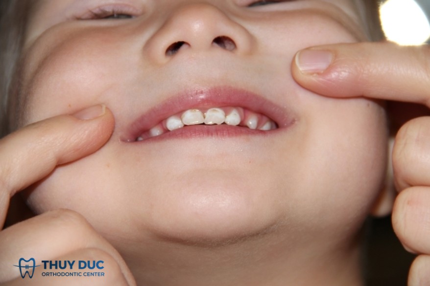 Răng trẻ mới mọc đã bị đen - xem ngay nguyên nhân là gì - Nha Khoa Thúy Đức