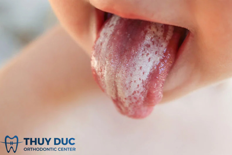 Trẻ bị đốm trắng trong miệng do nguyên nhân nào? - Nha Khoa Thúy Đức