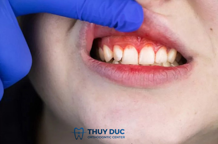 Hình ảnh viêm lợi ở trẻ em và cách điều trị tốt nhất - Nha Khoa Thúy Đức